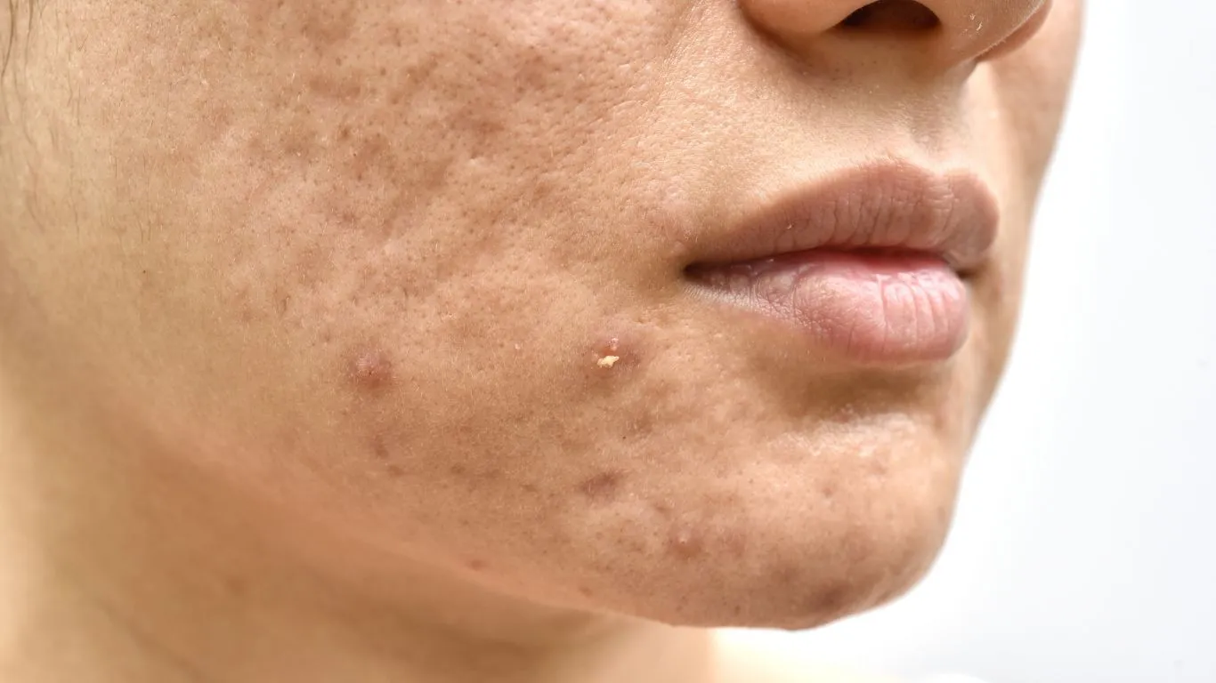 Acne scars